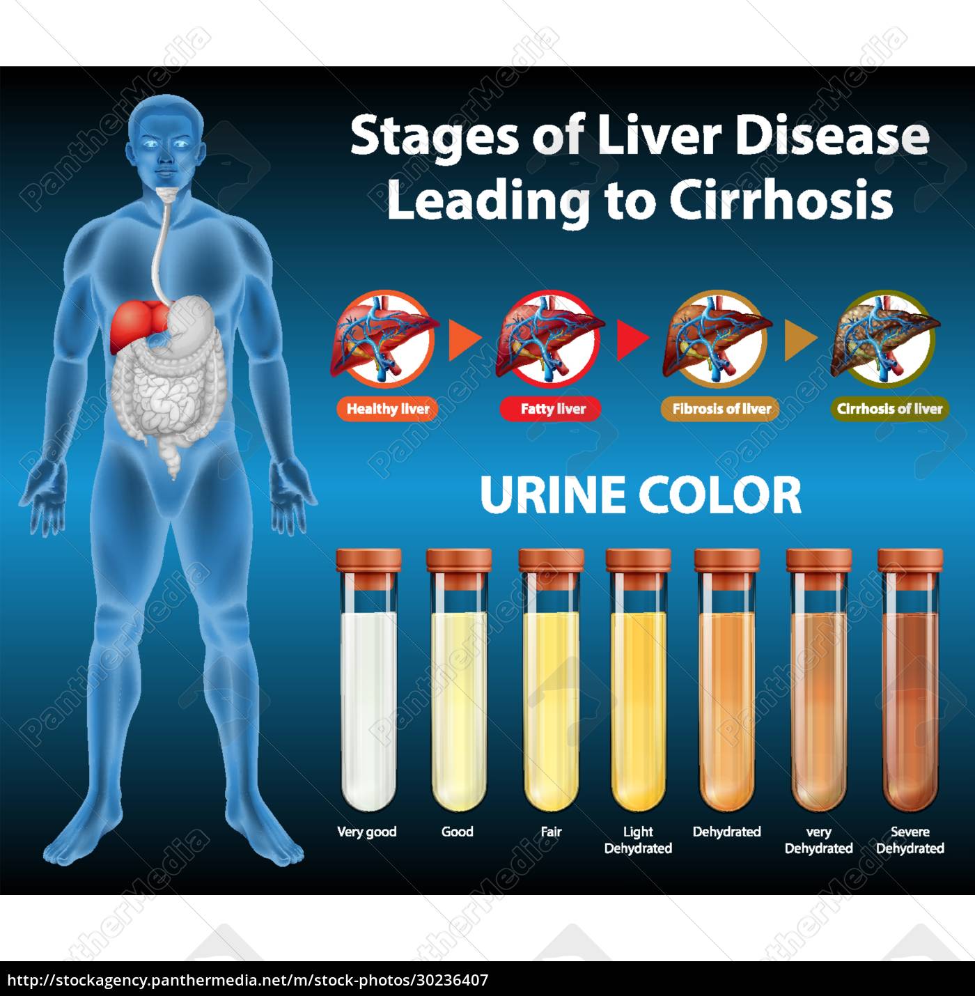 Stages of liver disease - Stock Photo - #30236407 | PantherMedia Stock ...